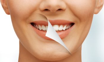 Sbiancamento Dentale Albania, Sbiancamento dei Denti Albania Dental Care Albania, Lo sbiancamento dentale è una procedura per migliorare il colore dei denti