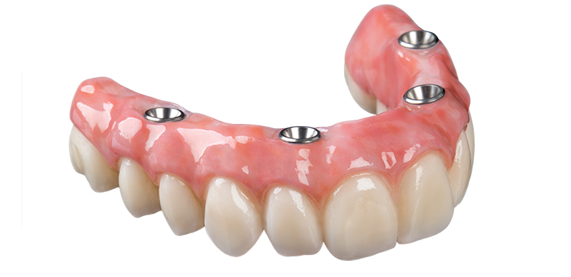 Protesi Dentali in Albania Prezzi - Dental Care Albania - Protesi Dentali Mobili Totali, Protesi Dentali Mobili Parziali, Protesi Dentali Fisse su Impianti
